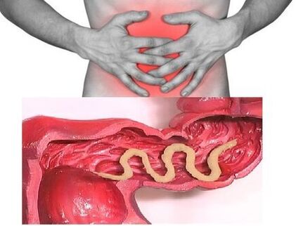 signs of chronic helminthiasis are dyspeptic intestinal disorder