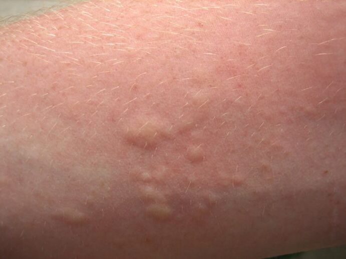 itchy allergic rashes can be symptoms of ascariasis