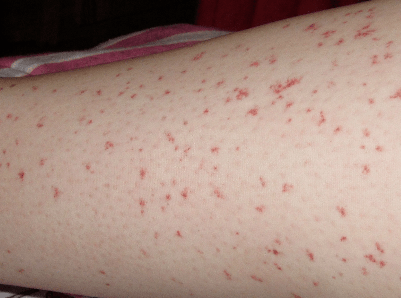 Skin rash is a sign of acute stage of worm infection